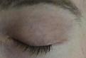 Here is my eyelid, it gets itchy and has very delicate skin